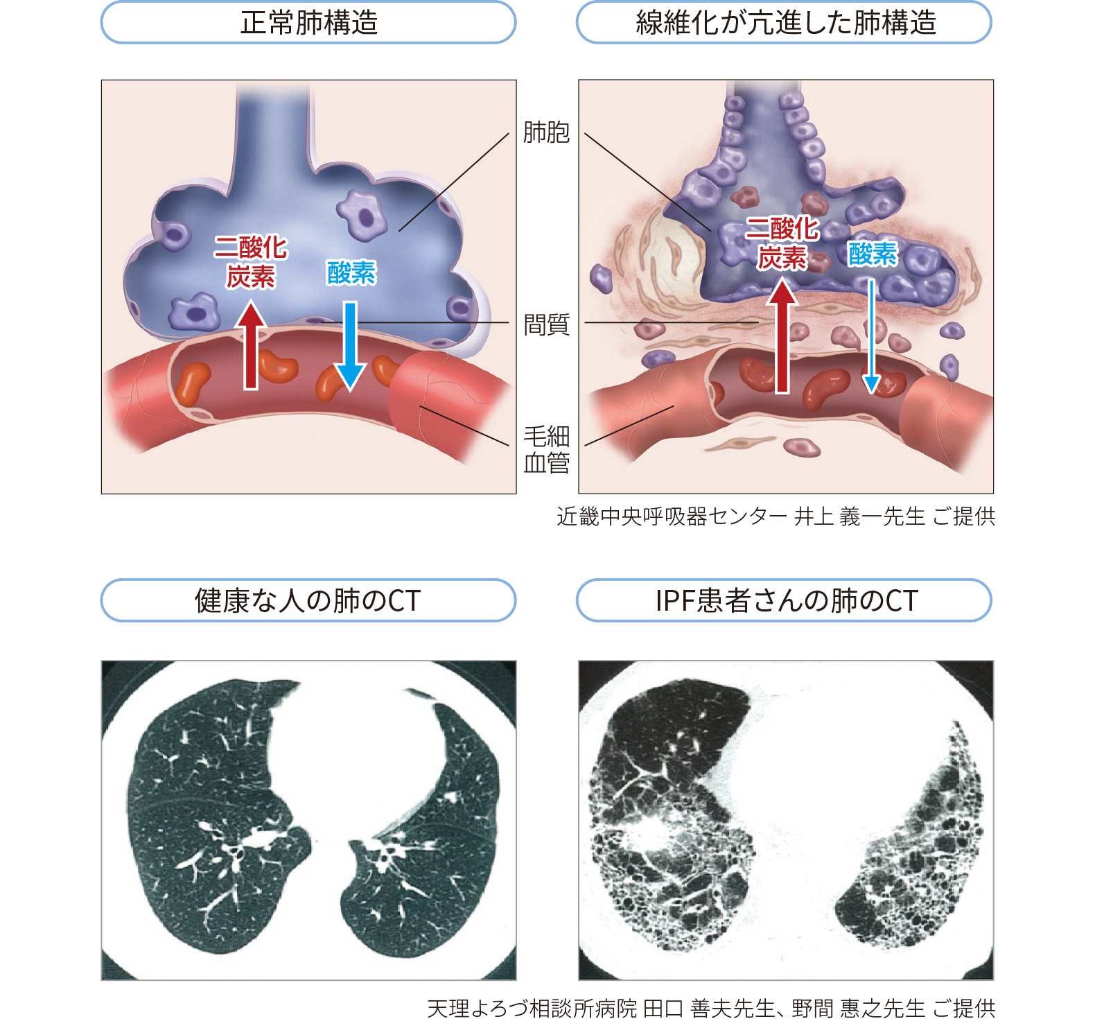 正常肺構造、線維化が亢進した肺構造、健康な人の肺のCT、IPF患者さんの肺のCT