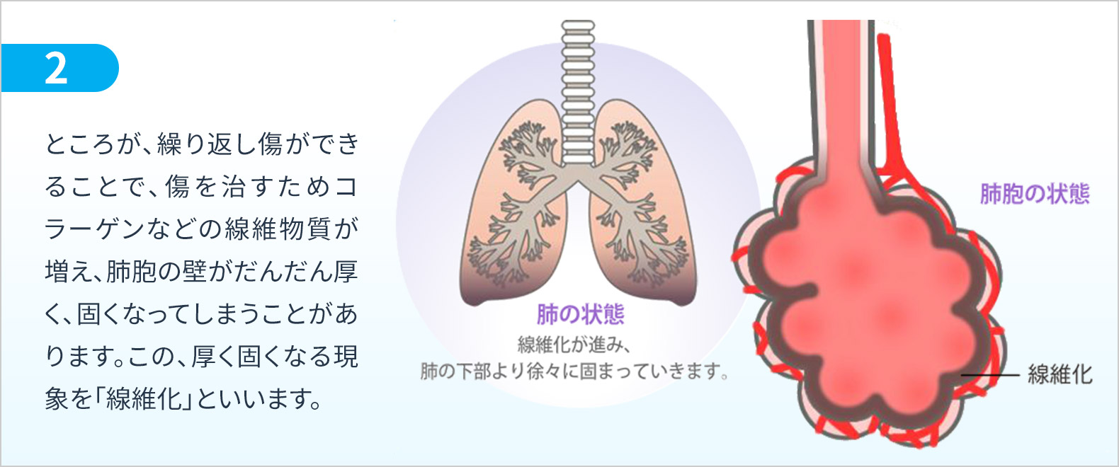 ところが、繰り返し傷ができることで、傷を治すためコラーゲンなどの線維物質が増え、肺胞の壁がだんだん厚く、固くなってしまうことがあります。この、厚く固くなる現象を「線維化」といいます。