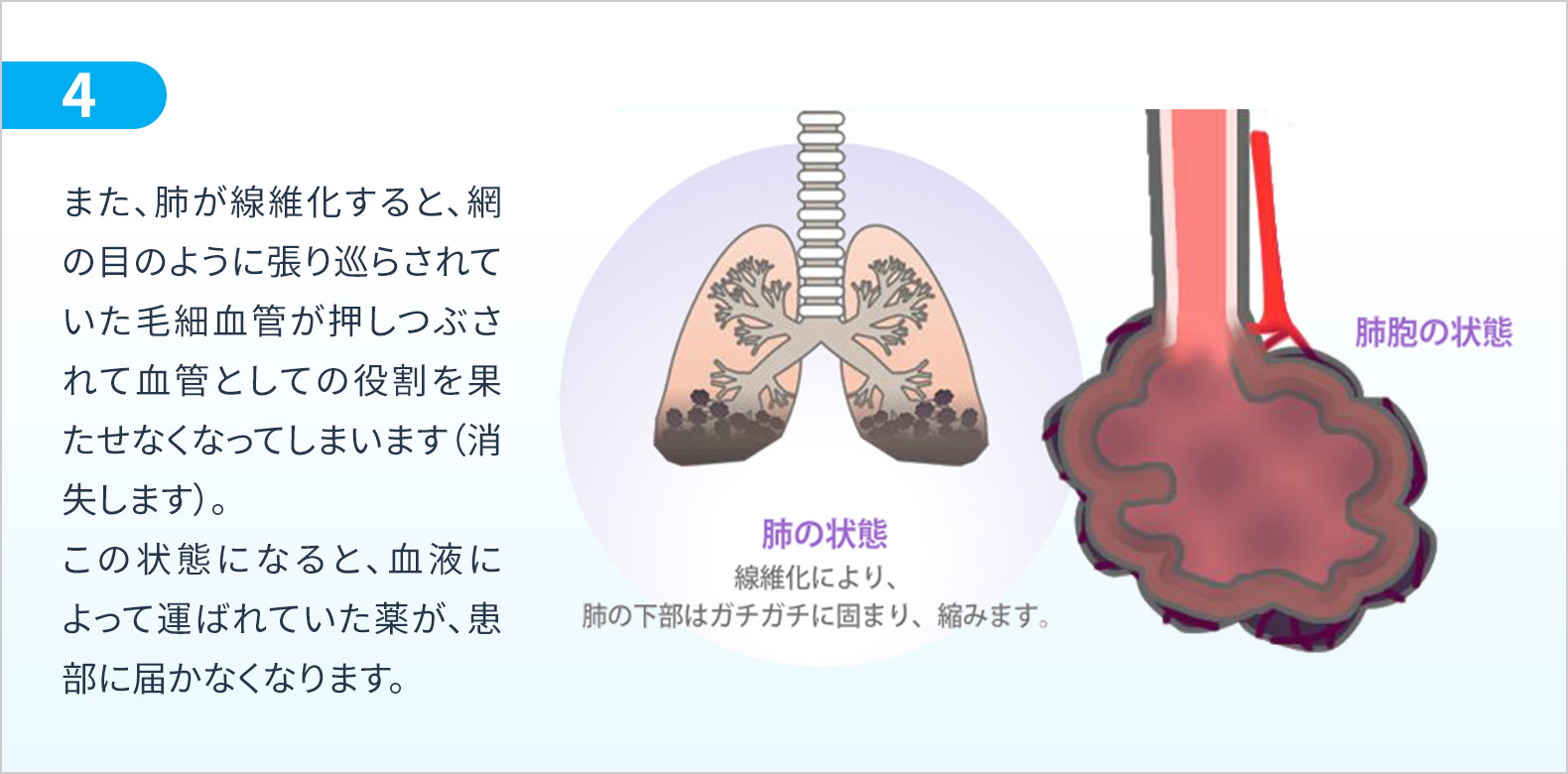 また、肺が線維化すると、網の目のように張り巡らされていた毛細血管が押しつぶされて血管としての役割を果たせなくなってしまいます（消失します）。この状態になると、血液によって運ばれていた薬が、患部に届かなくなります。