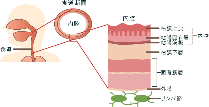 食道がんの特徴 がんのつらさ 痛みや症状をつたえて シオノギ製薬 塩野義製薬 食道がんの特徴 がんのつらさ 痛みや症状をつたえて シオノギ製薬 塩野義製薬