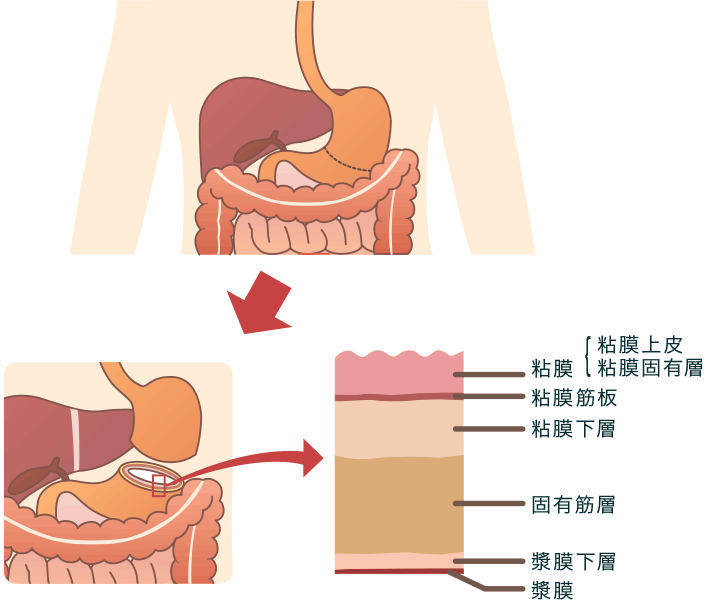 胃がんの特徴 がんのつらさ 痛みや症状をつたえて シオノギ製薬 塩野義製薬