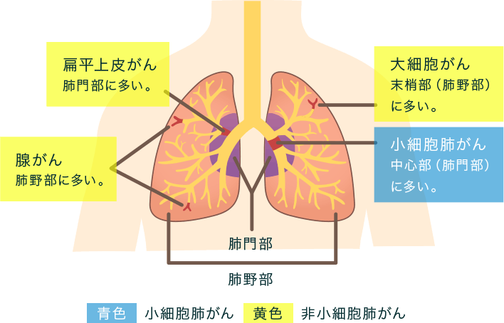 肺がんの特徴 がんのつらさ 痛みや症状をつたえて シオノギ製薬 塩野義製薬